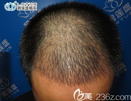 植发三个月遇上了脱落期