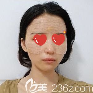 面部脂肪填充后粘的固定胶带