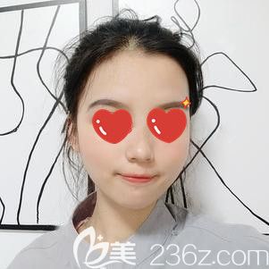 脂肪填充18天面部饱满