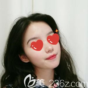 面部填充术后47天脂肪少数被吸收