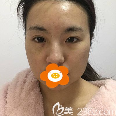 做面部吸脂手术前的照片 做面部吸脂手术前的照片