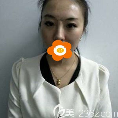 术后半个月有点憔悴 术后半个月有点憔悴