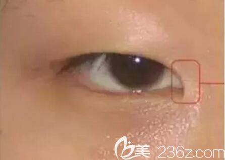 内眦赘皮 内眦赘皮