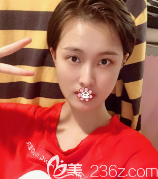 自体脂肪填充术后一个月 自体脂肪填充术后一个月