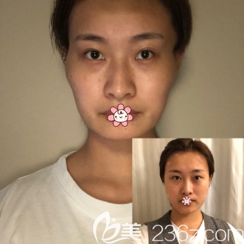 术前术后对比 术前术后对比