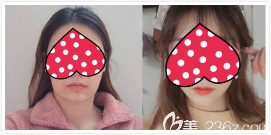 长曲线下颌角截骨一年后对比