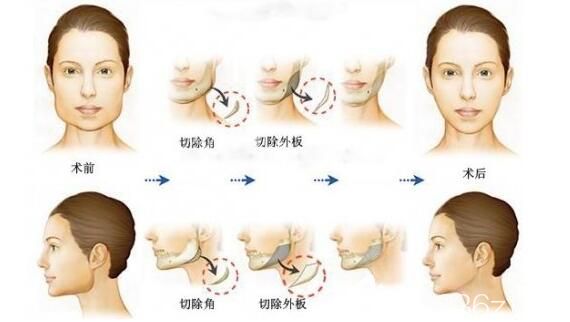 下颌角截骨手术原理示意图