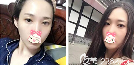 老实说我也惊讶头一回做内切祛眼袋手术没失败没凹陷也看不出疤