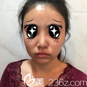 面诊隆鼻手术前大鼻头的自己 面诊隆鼻手术前大鼻头的自己