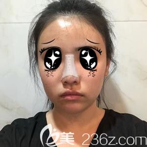 刚做完肋软骨隆鼻手术的我 刚做完肋软骨隆鼻手术的我