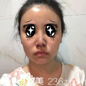 隆鼻术后第7天拆线后和术前没啥变化 隆鼻术后第7天拆线后和术前没啥变化