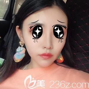 鼻综合术后35天效果逐渐显现 鼻综合术后35天效果逐渐显现