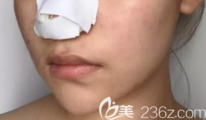 隆鼻术中照片