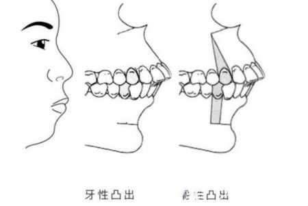 骨性和牙性凸嘴对比示意图