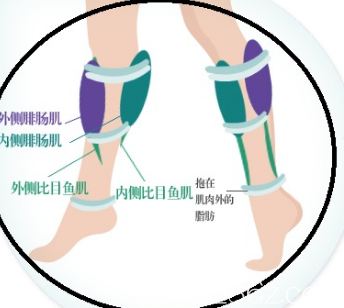 小腿神经切断术