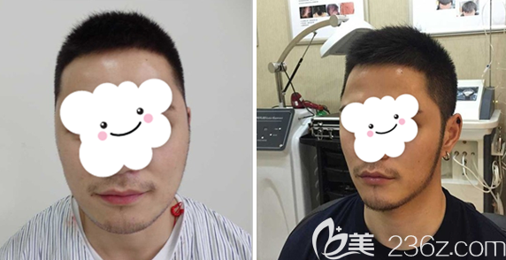 通过种植鬓角前后对比图看得出我的要求达到了 通过种植鬓角前后对比图看得出我的要求达到了