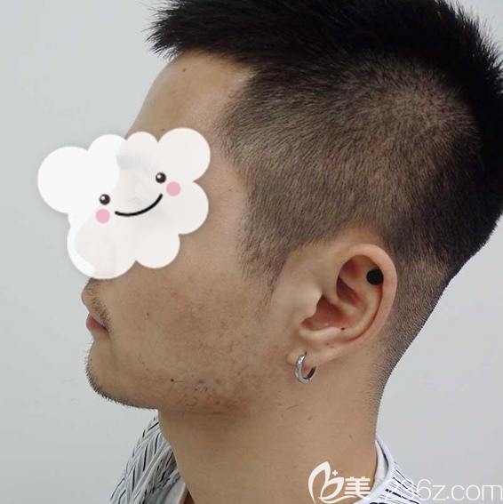 我是先天条件不足才选择种植鬓角的 我是先天条件不足才选择种植鬓角的