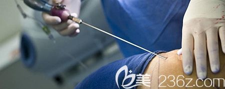 腹部吸脂手术的过程和原理