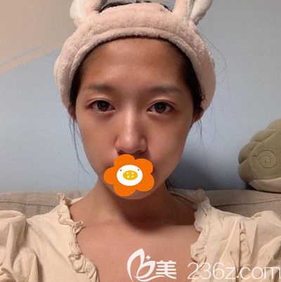 做面部填充手术前的我 做面部填充手术前的我