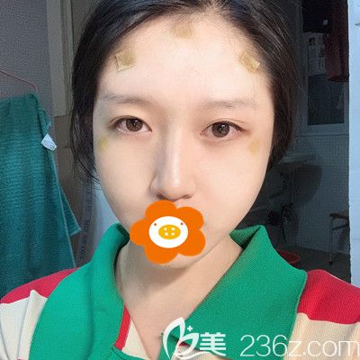 术后第3天脸上贴着胶布 术后第3天脸上贴着胶布