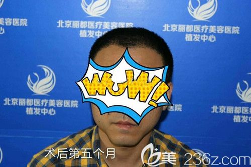 前额头发稀疏脱发做大面积植发3500毛囊单位后魅力“发”生