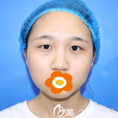 做眼整形手术前的我 做眼整形手术前的我