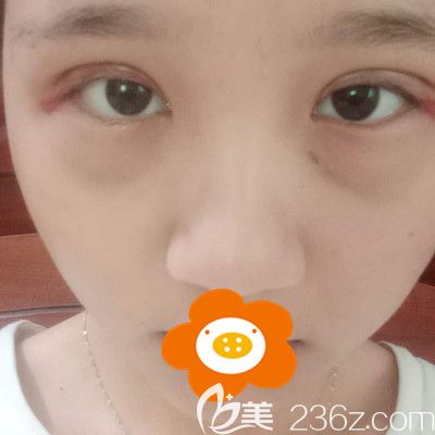 手术后第5天眼尾红红的 手术后第5天眼尾红红的