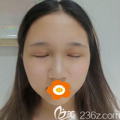 术后20多天眼皮还有点红 术后20多天眼皮还有点红