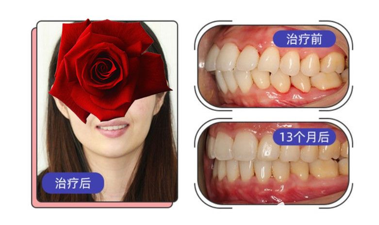  Insignia牙套的费用