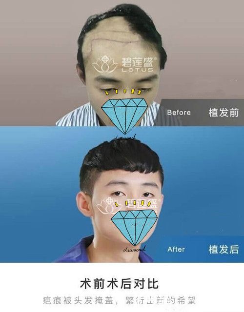 疤痕植发术前术后效果对比