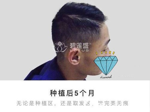 无论是种植区还是取发区都已经无痕恢复