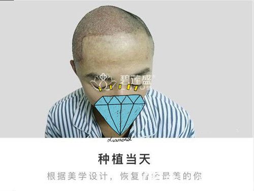 疤痕植发术后即刻效果图