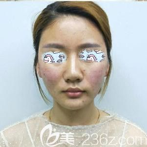 刚做完埋线提升出来脸部泛红 刚做完埋线提升出来脸部泛红