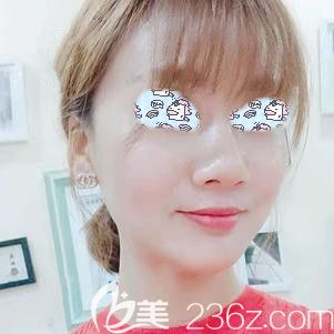 埋线提升术后8天组织已经提升 埋线提升术后8天组织已经提升