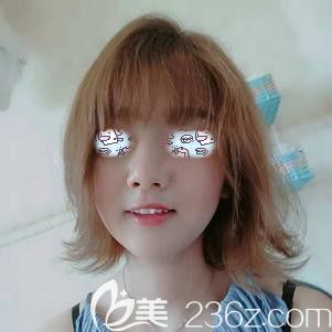 埋线提升术后35天脸部下垂基本看不到了 埋线提升术后35天脸部下垂基本看不到了