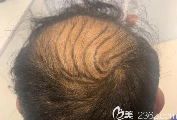 毛囊检测后医生给我设计的植发手术方案