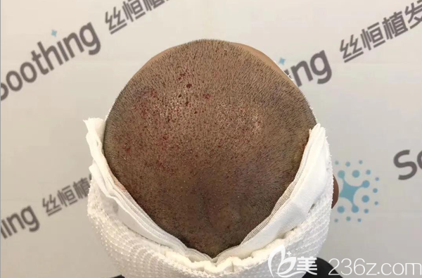 植发失败修复手术术后效果