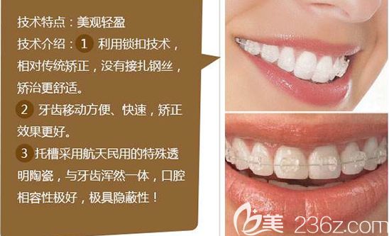 张杨医生对半隐形陶瓷托槽矫正的优势介绍 张杨医生对半隐形陶瓷托槽矫正的优势介绍
