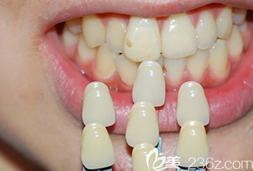 李孝枫医生讲解不同症状牙齿修复的方法