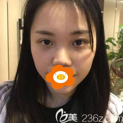 做隆鼻手术前我的照片 做隆鼻手术前我的照片