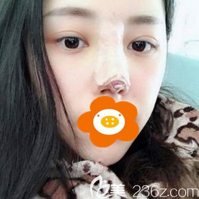 术后第5天鼻子还包着纱布 术后第5天鼻子还包着纱布