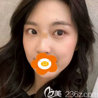 术后半个月效果 术后半个月效果