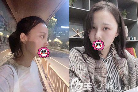 杭州时光胡斌做鼻子怎么样? 杭州时光胡斌做鼻子怎么样?