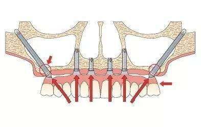 穿颧穿翼种植技术 穿颧穿翼种植技术