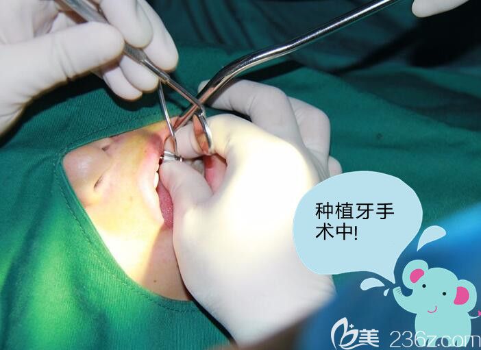 种植牙手术过程 种植牙手术过程