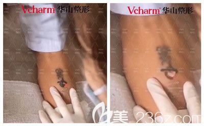 皮秒洗纹身后即刻的改变 皮秒洗纹身后即刻的改变