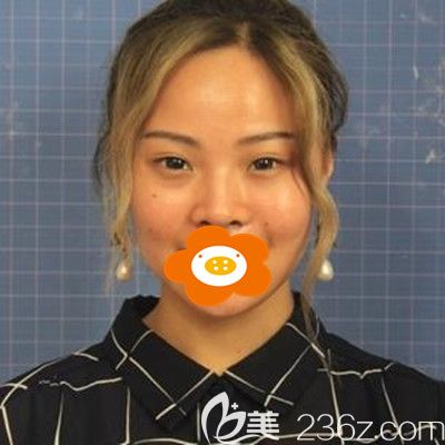 做鼻整形手术前的照片 做鼻整形手术前的照片