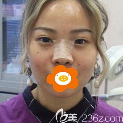 术后一周拍的照 术后一周拍的照