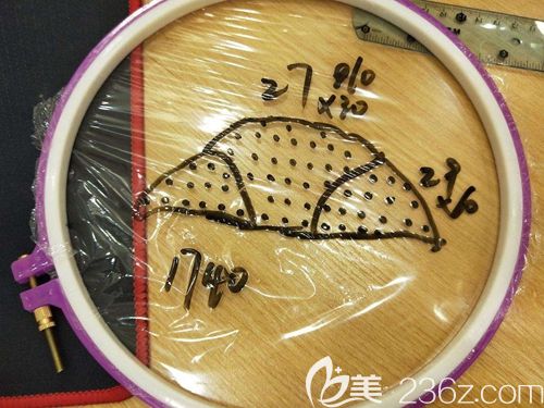 发际线调整费用的计算方法 发际线调整费用的计算方法