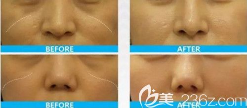 热玛吉去印第安纹真人案例